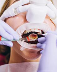Клиновидный дефект зуба: что это?