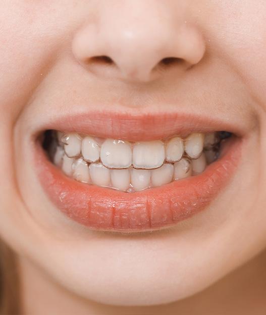 Бруксизм: как распознать и лечить